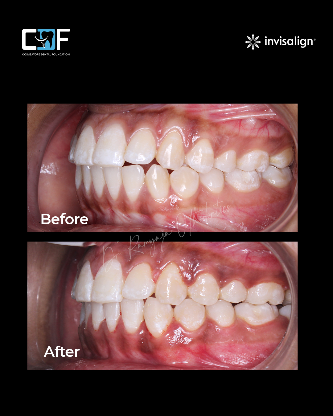Before After Result